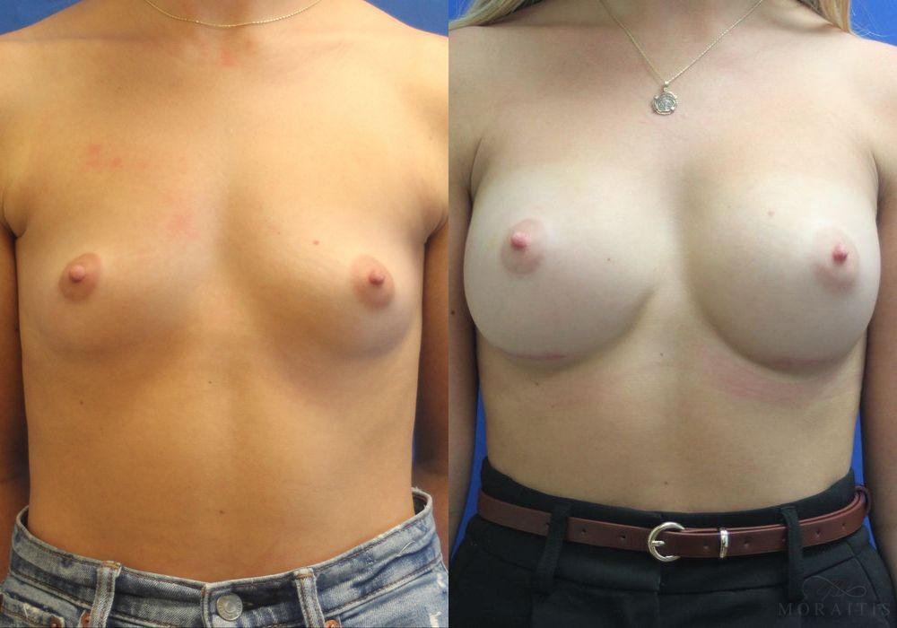 Breast Augmentation - Case 15375