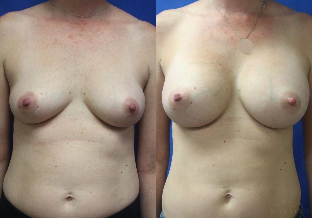 Breast Augmentation - Case 15404