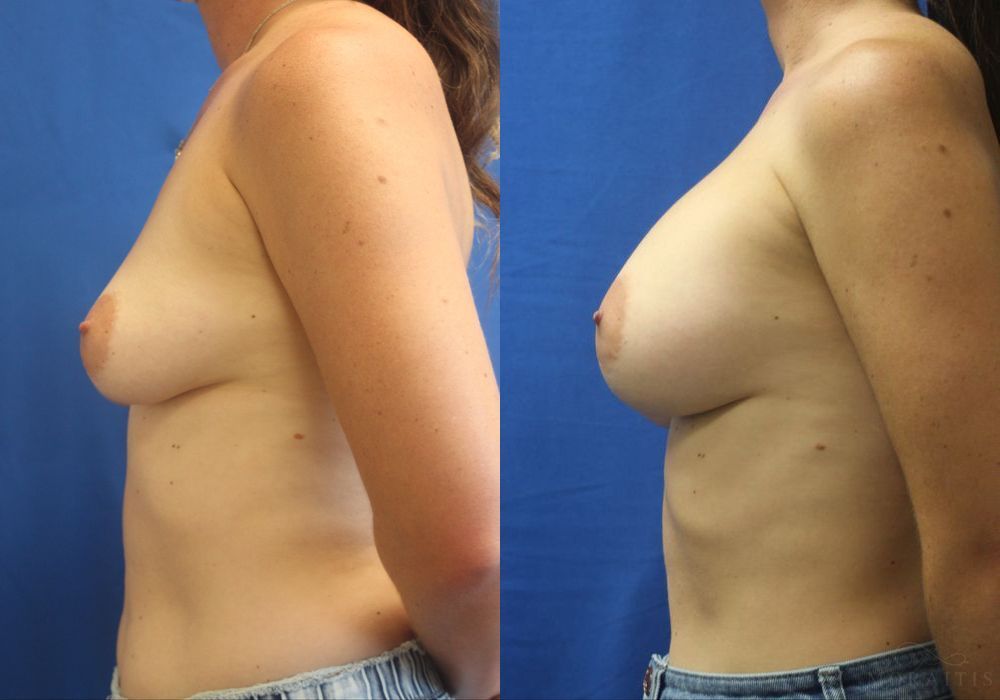 Breast Augmentation - Thumbnail 3