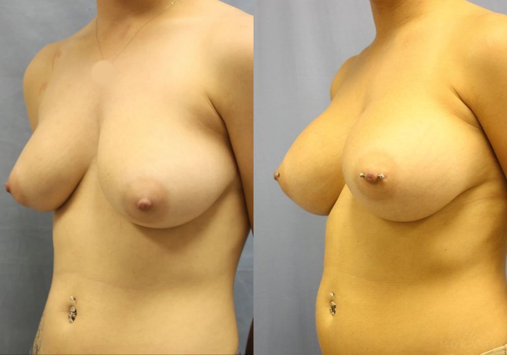 Breast Augmentation - Thumbnail 2