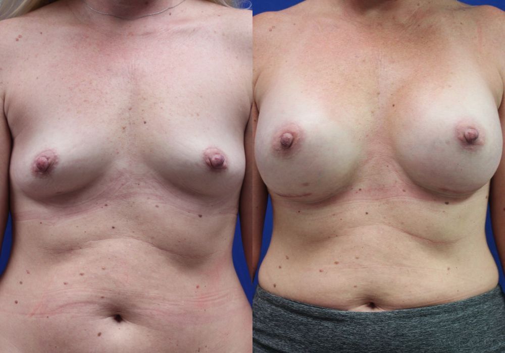Breast Augmentation - Case 15400