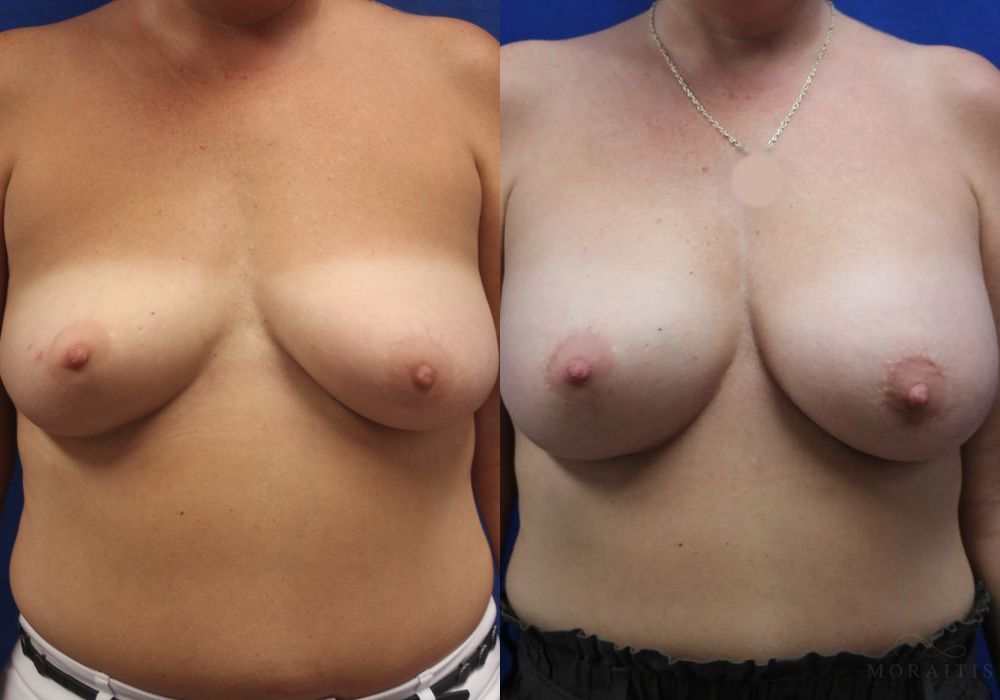 Breast Augmentation - Case 15621