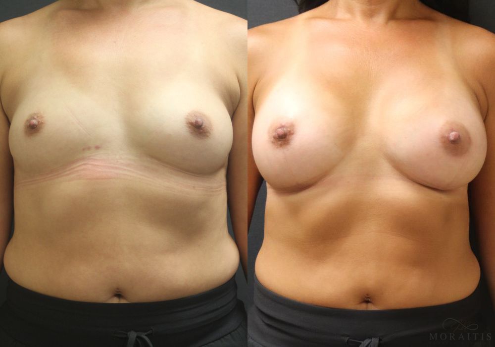 Breast Augmentation - Case 15372