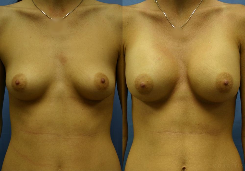 Breast Augmentation - Case 15378