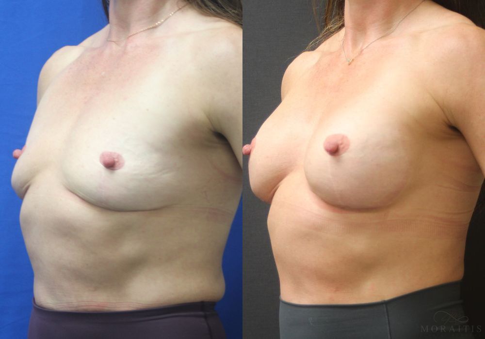 Breast Augmentation - Thumbnail 2