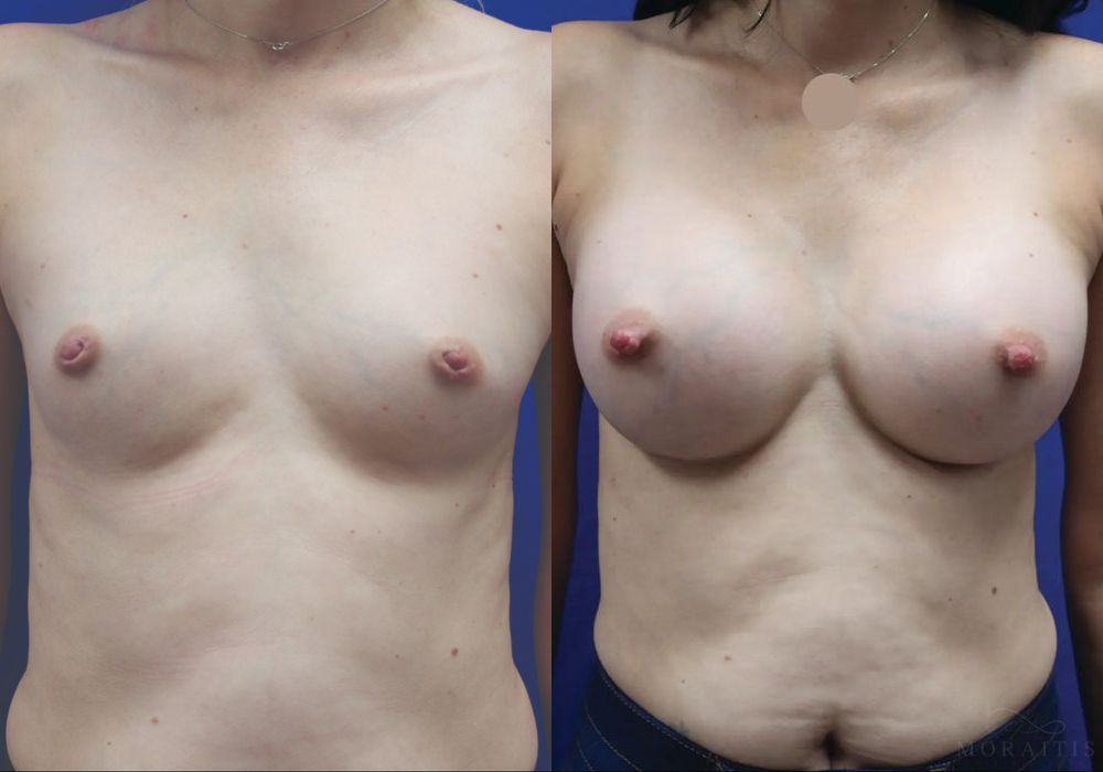 Breast Augmentation - Case 15397