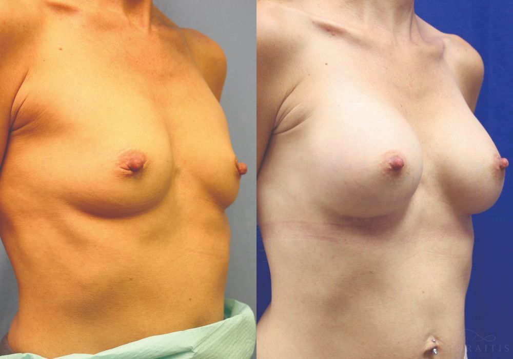Breast Augmentation - Thumbnail 2