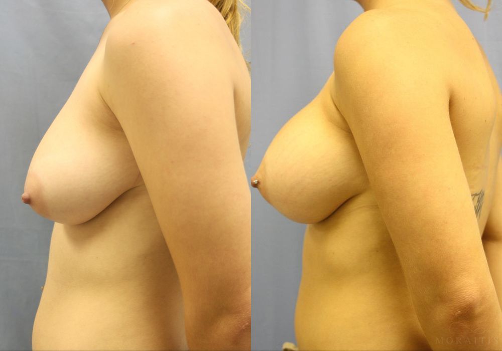 Breast Augmentation - Thumbnail 3