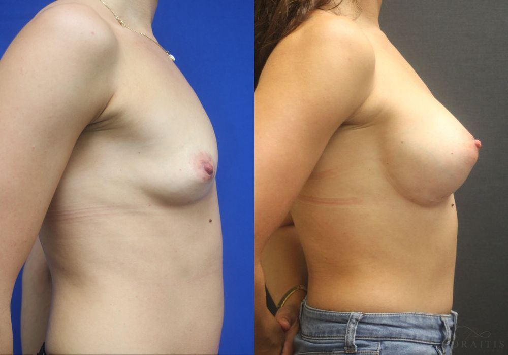 Breast Augmentation - Thumbnail 3
