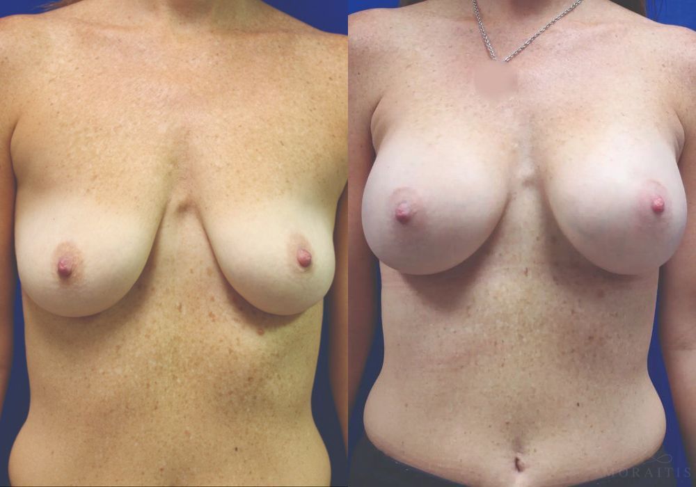 Breast Augmentation - Case 15387
