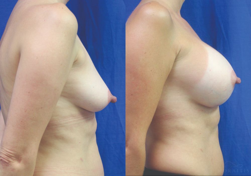 Breast Augmentation - Thumbnail 3