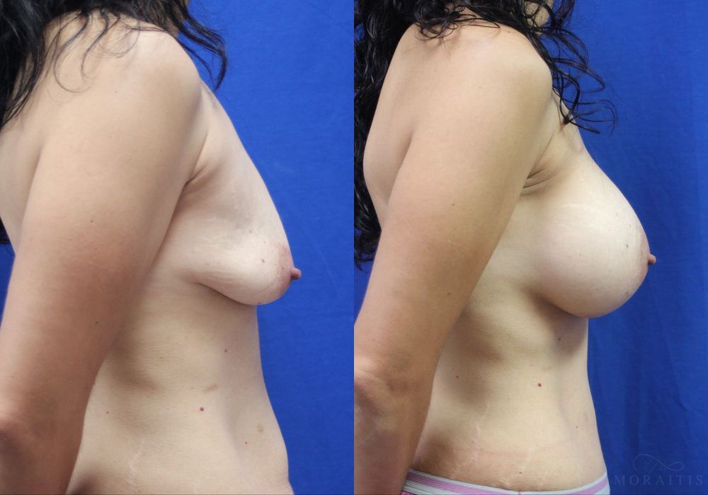 Breast Augmentation - Thumbnail 3