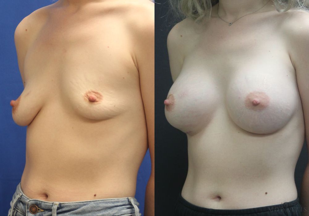 Breast Augmentation - Thumbnail 2
