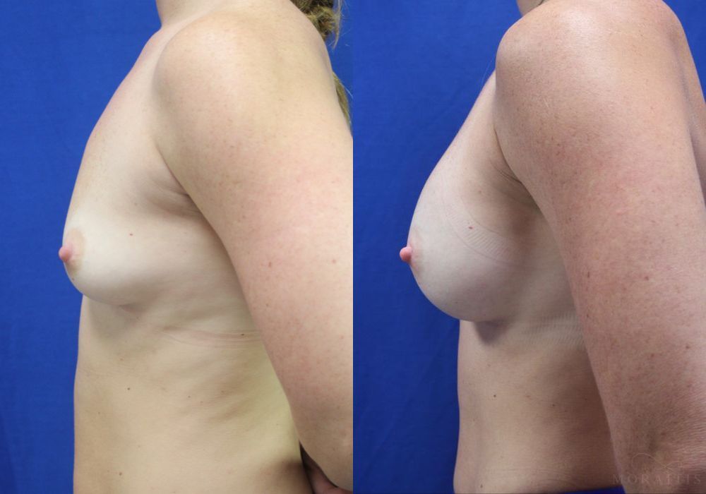 Breast Augmentation - Thumbnail 3