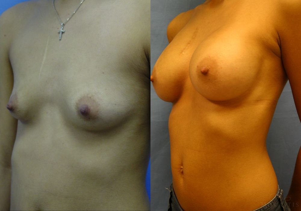 Breast Augmentation - Thumbnail 2