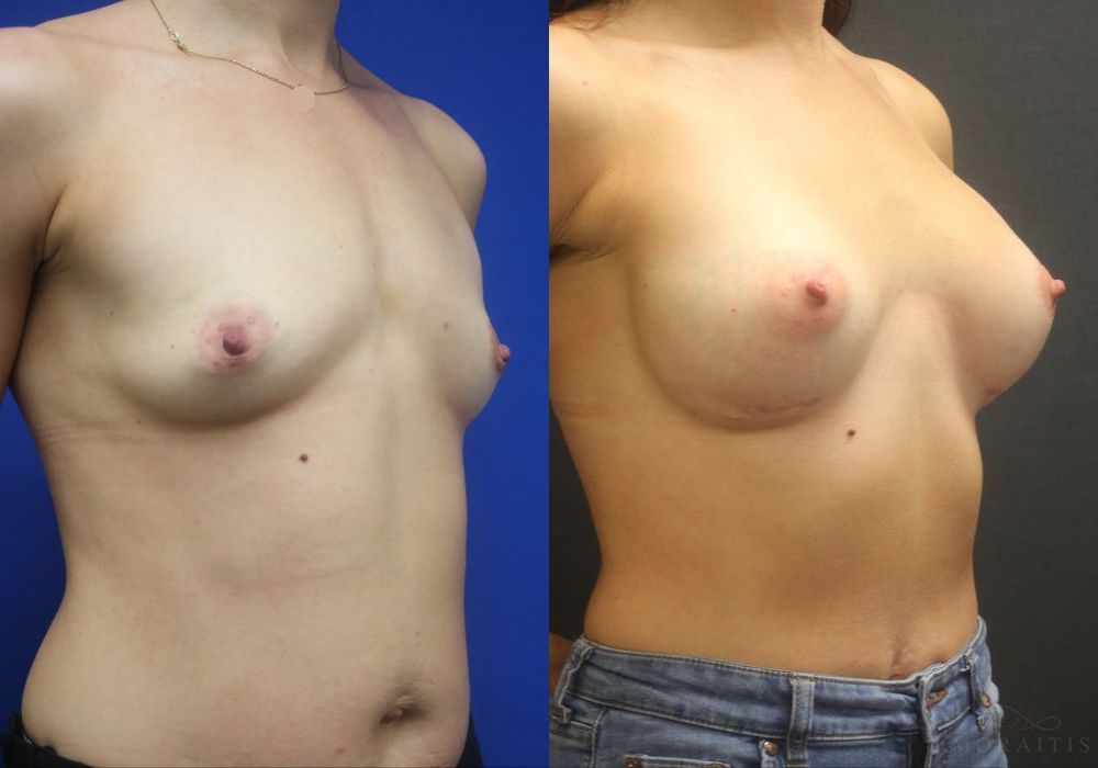 Breast Augmentation - Thumbnail 2