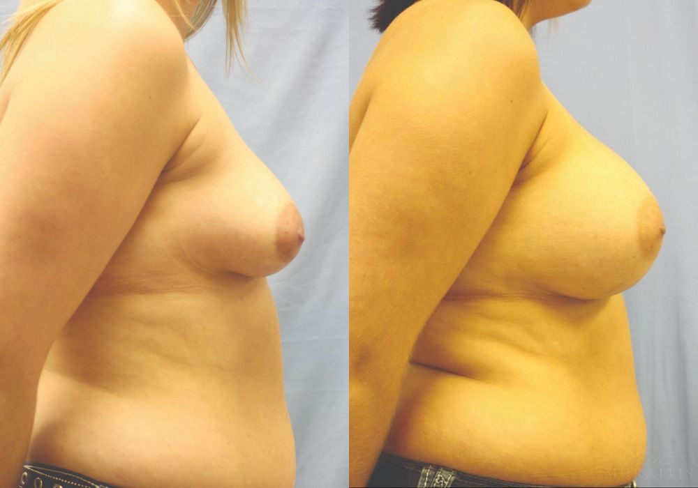 Breast Augmentation - Thumbnail 3