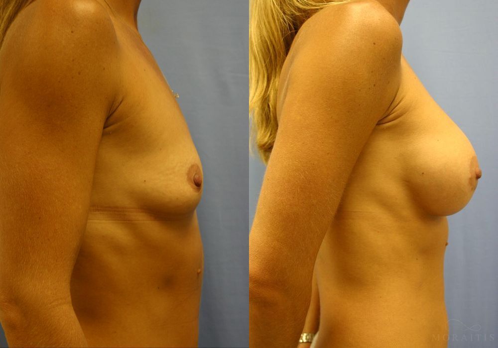 Breast Augmentation - Thumbnail 3