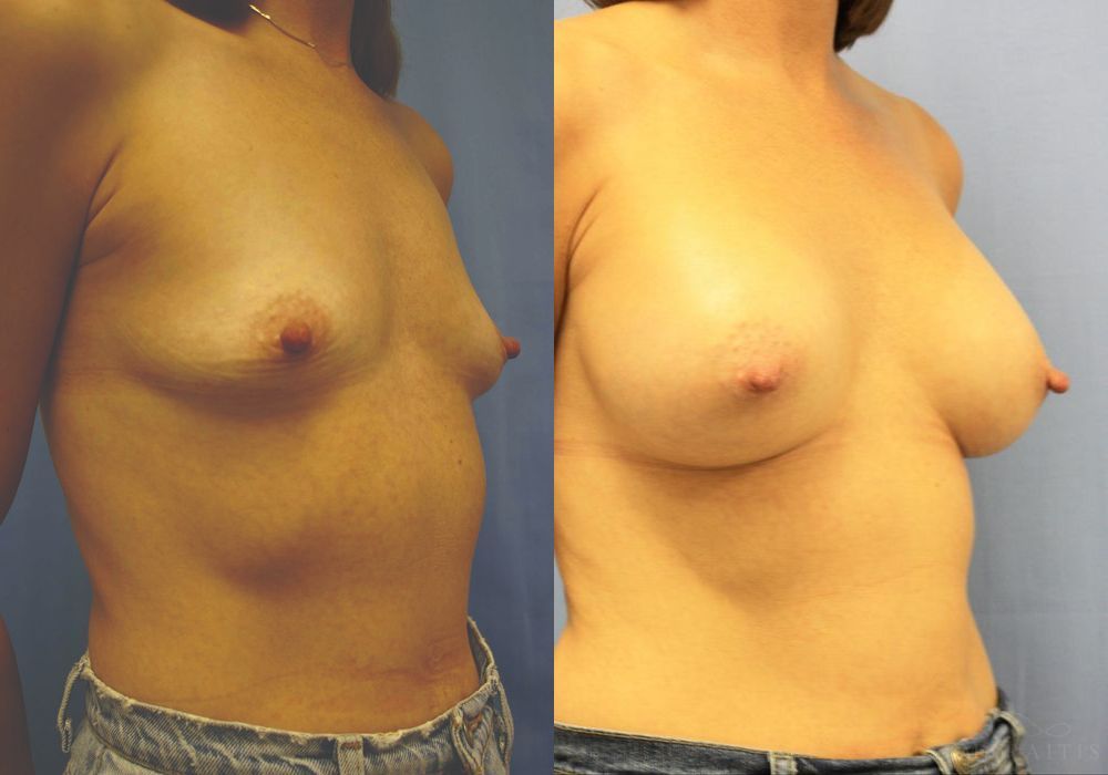 Breast Augmentation - Thumbnail 2