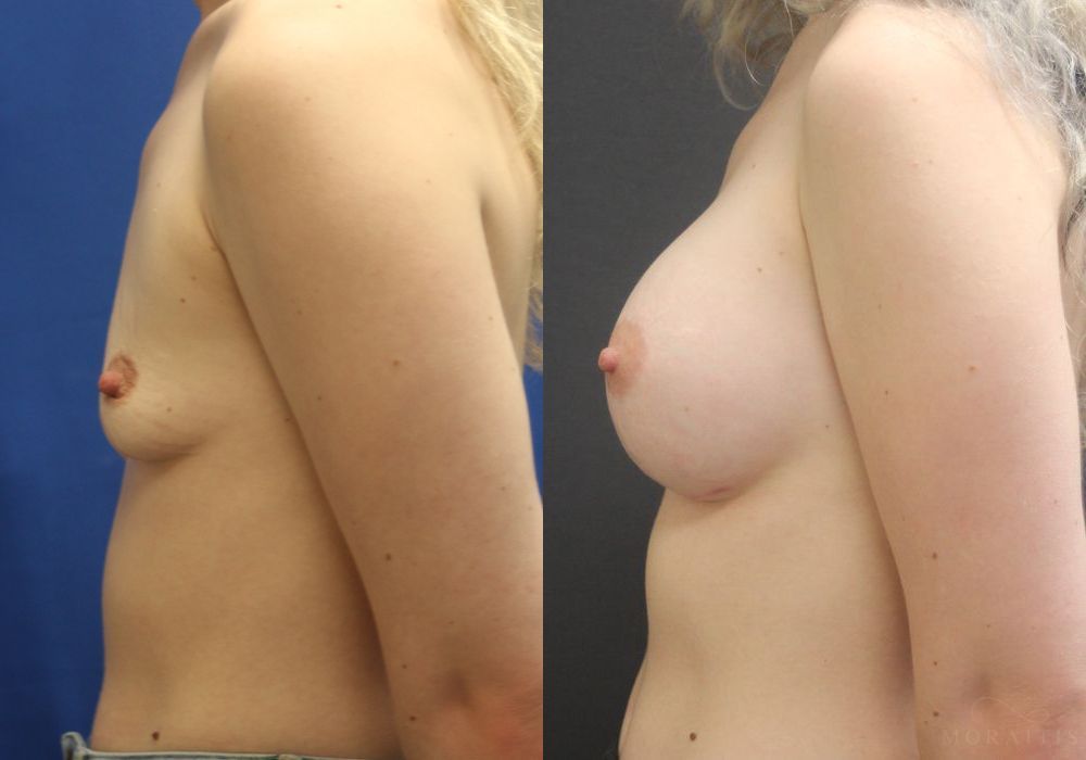 Breast Augmentation - Thumbnail 3