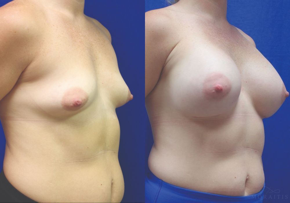 Breast Augmentation - Thumbnail 2