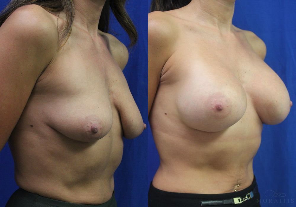 Breast Augmentation - Thumbnail 2