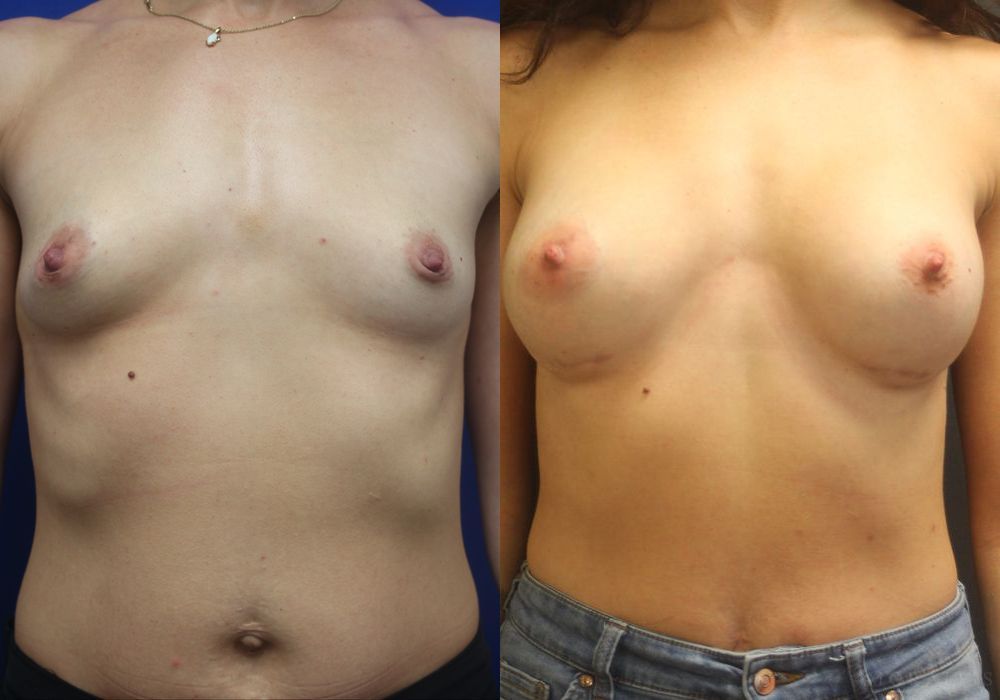 Breast Augmentation - Case 15405