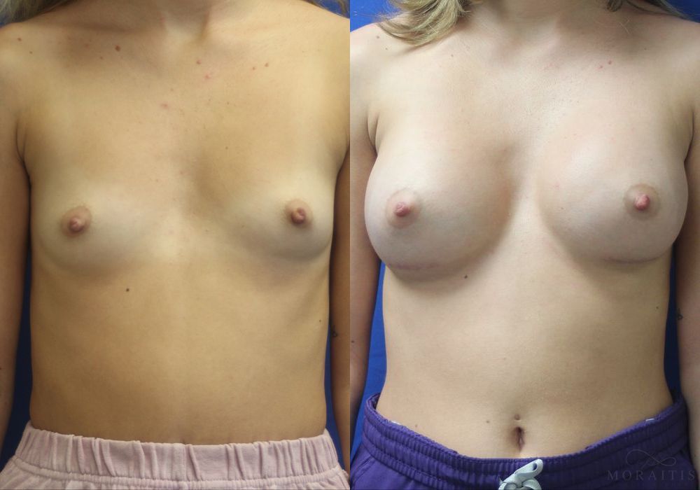 Breast Augmentation - Case 15376