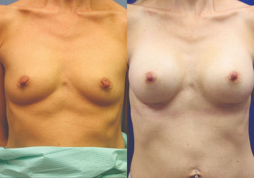 Breast Augmentation - Case 15381