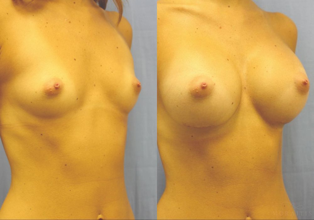 Breast Augmentation - Thumbnail 2