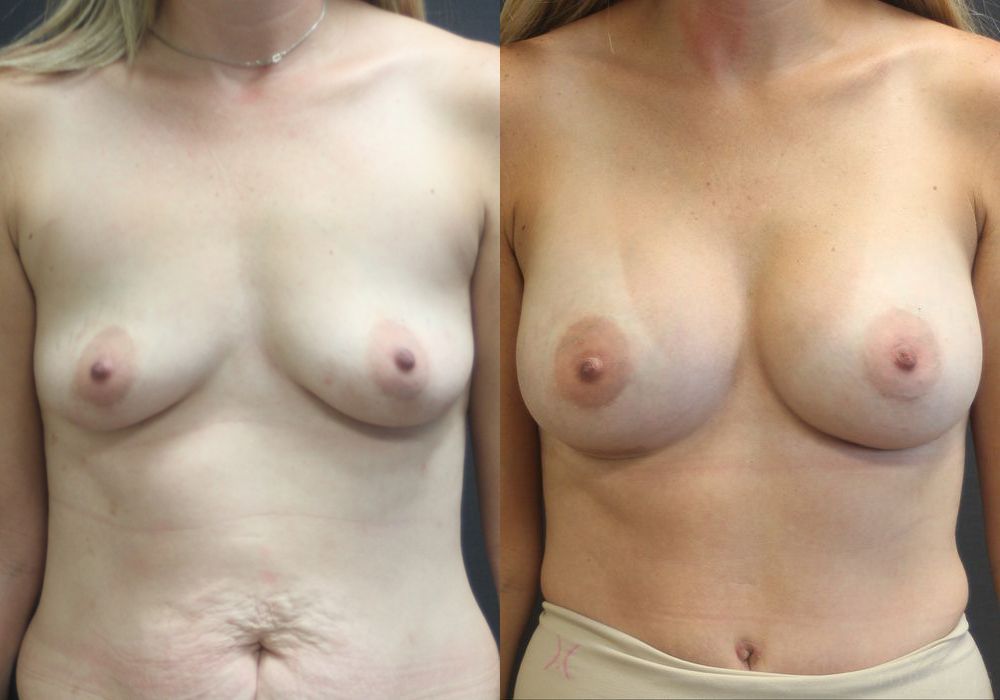Breast Augmentation - Case 15411
