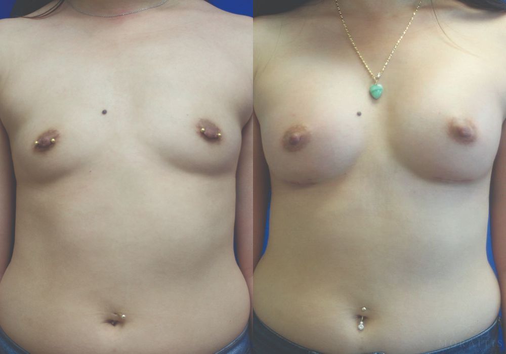 Breast Augmentation - Case 15380