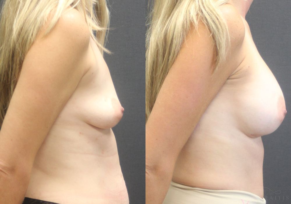 Breast Augmentation - Thumbnail 3