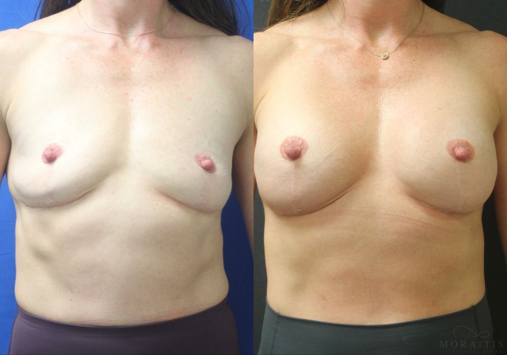 Breast Augmentation - Case 15412