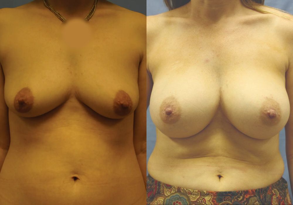 Breast Augmentation - Case 15382