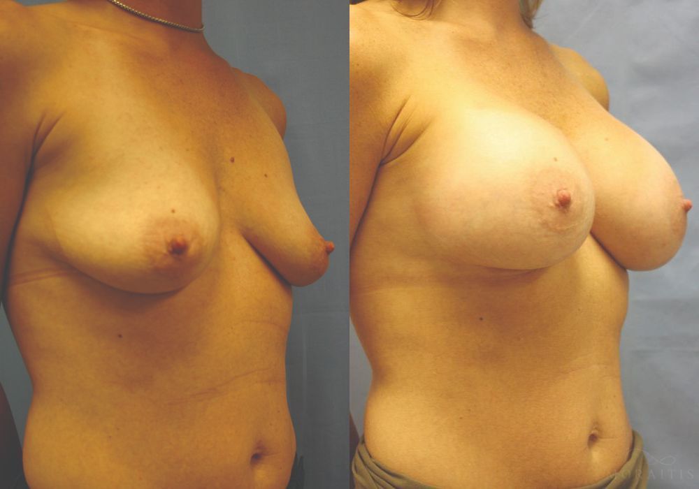 Breast Augmentation - Thumbnail 2