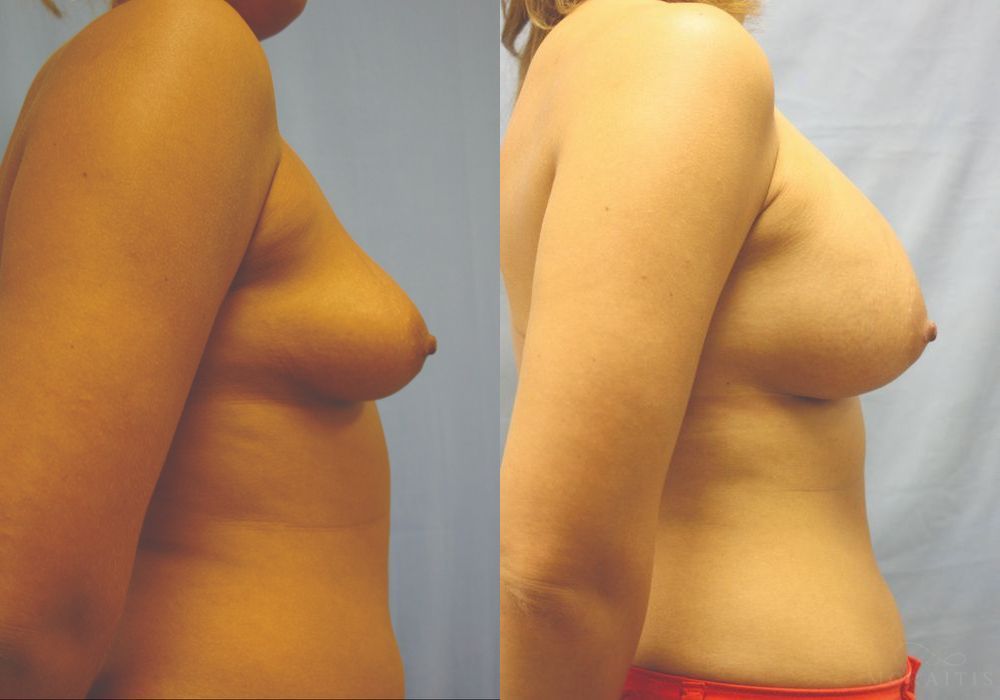 Breast Augmentation - Thumbnail 3