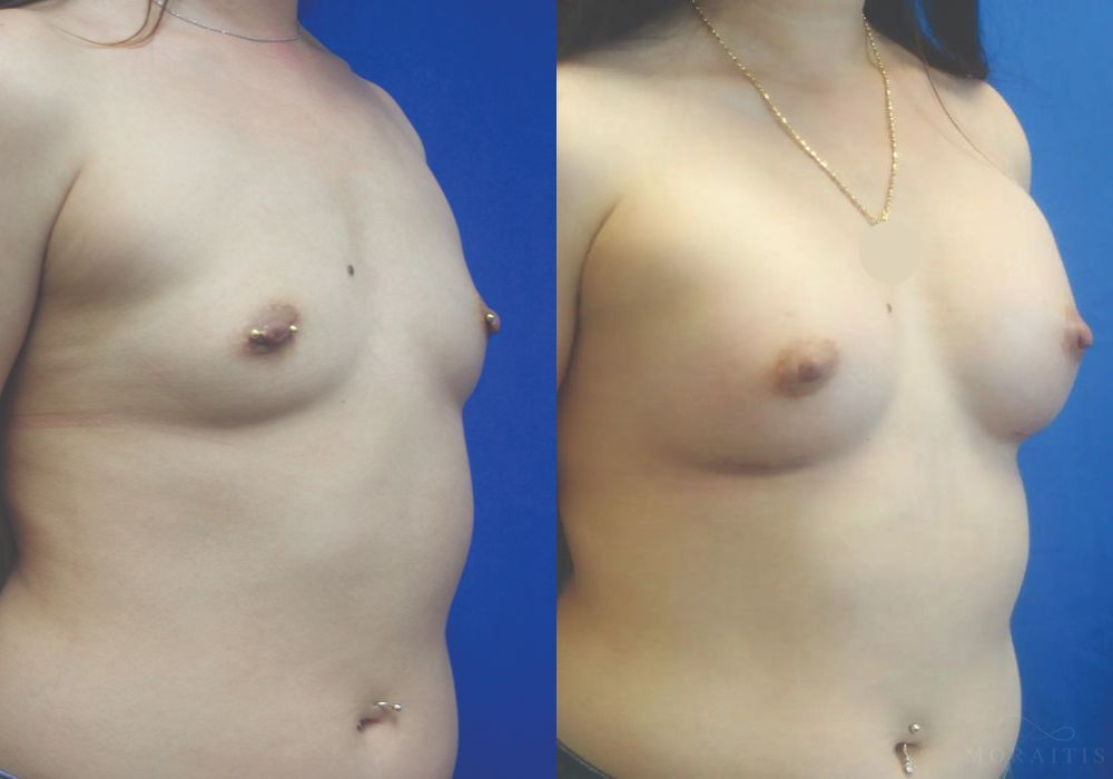 Breast Augmentation - Thumbnail 2