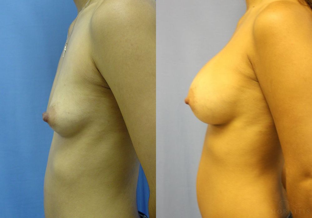 Breast Augmentation - Thumbnail 3