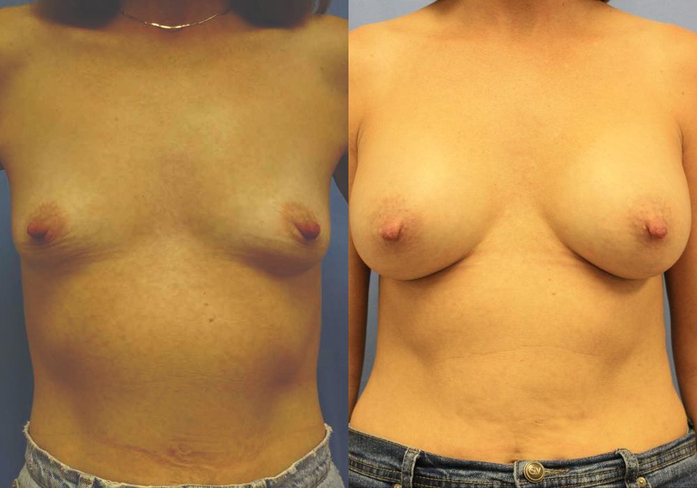 Breast Augmentation - Case 15393