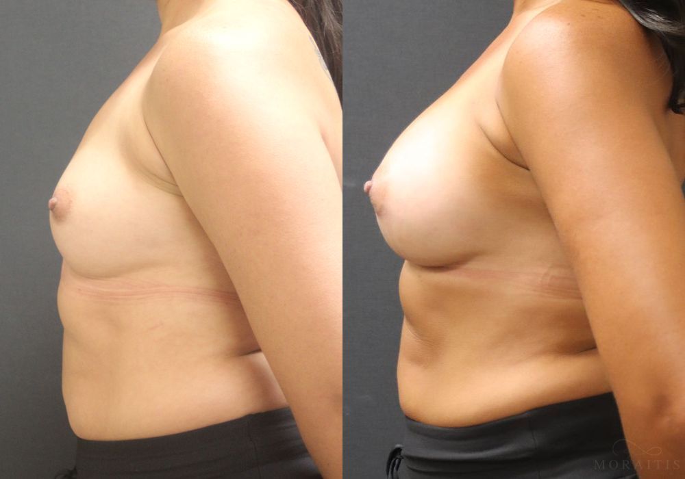 Breast Augmentation - Thumbnail 3