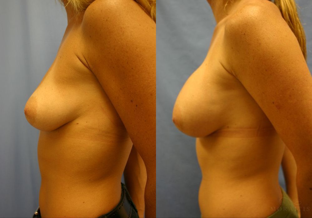 Breast Augmentation - Thumbnail 3