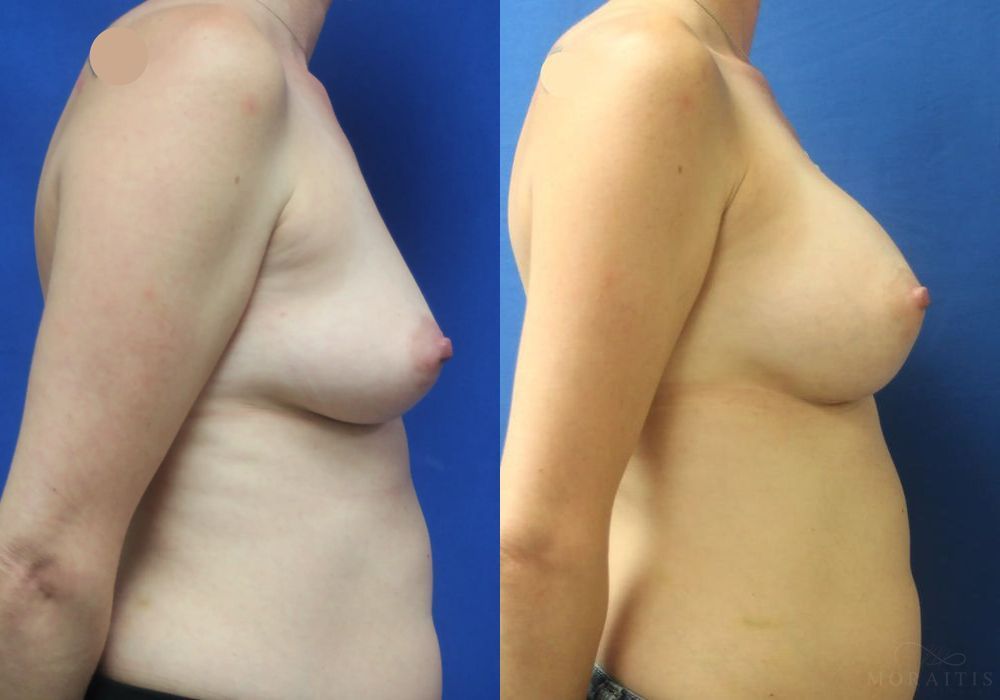 Breast Augmentation - Thumbnail 3