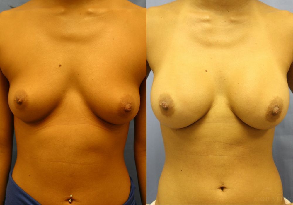 Breast Augmentation - Case 15518