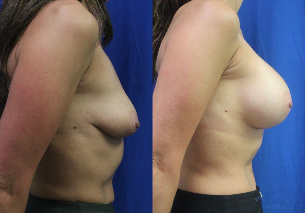 Breast Augmentation - Thumbnail 3