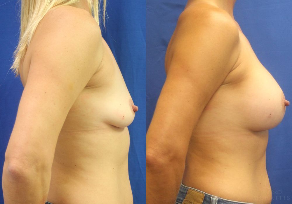 Breast Augmentation - Thumbnail 3