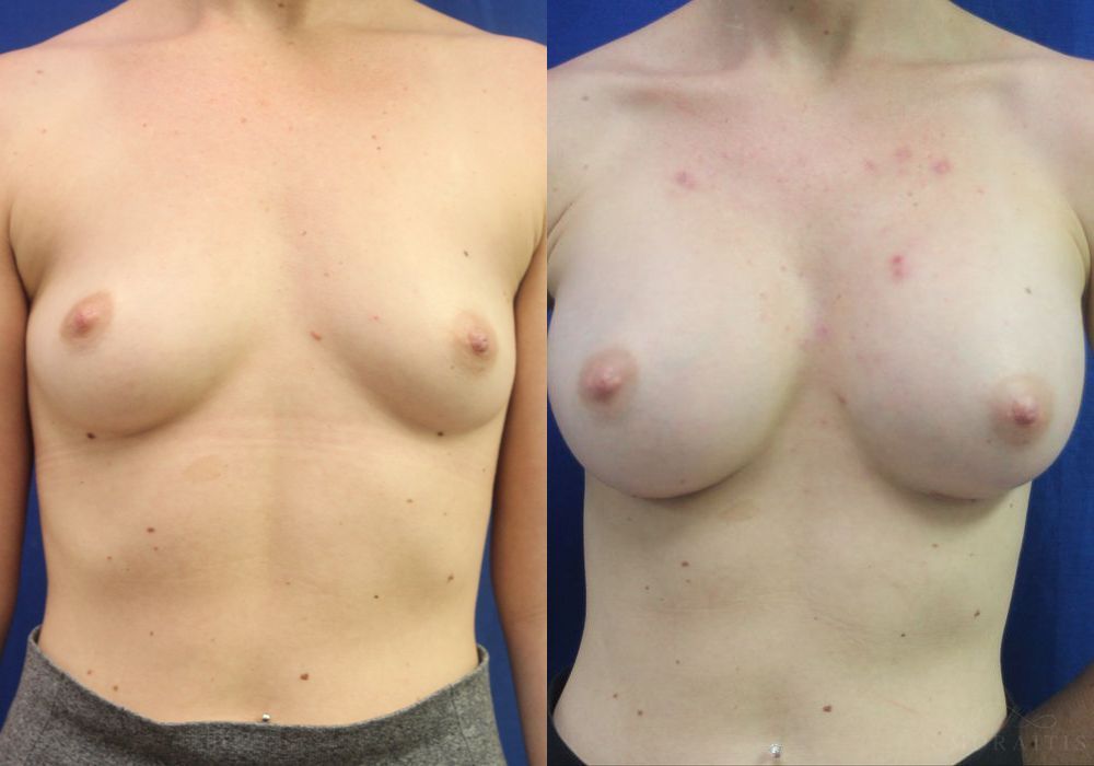 Breast Augmentation - Case 15408