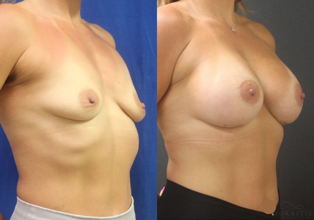 Breast Augmentation - Thumbnail 2