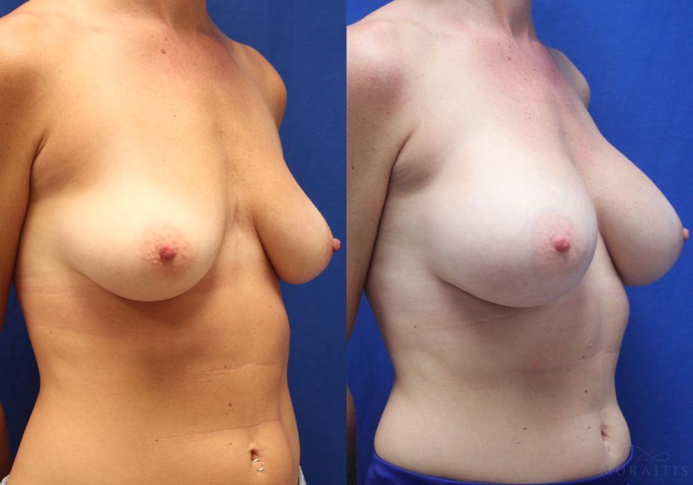 Breast Augmentation - Thumbnail 2