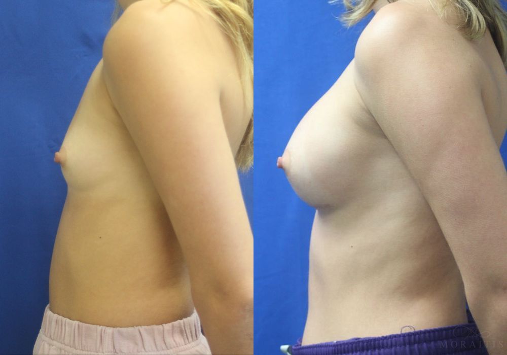 Breast Augmentation - Thumbnail 3